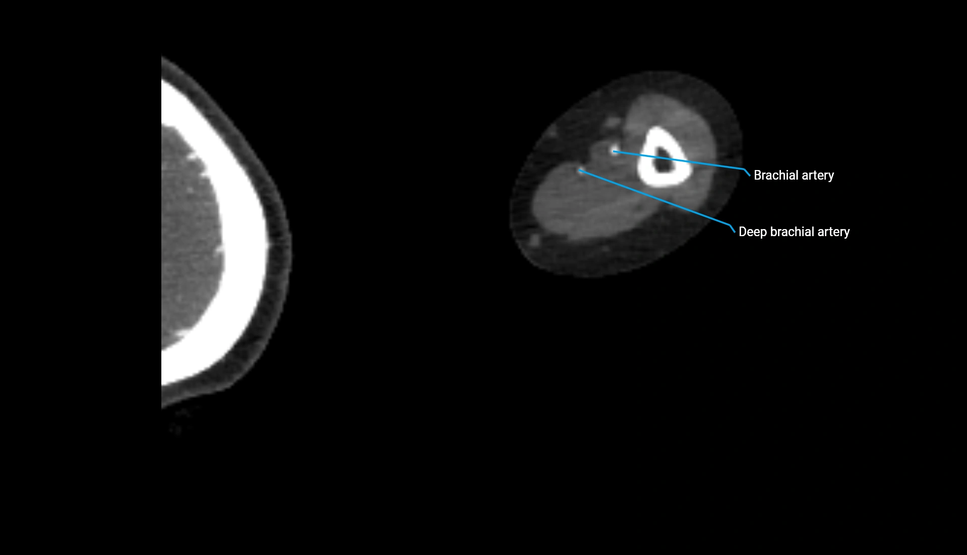 CTA upper limb axial cross sectional anatomy labelled image 216 (2).webp